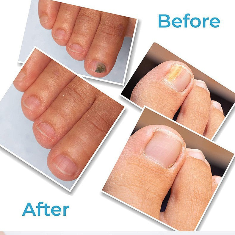 Nail Fungus Repair Pen – Hand and Foot Nail Care